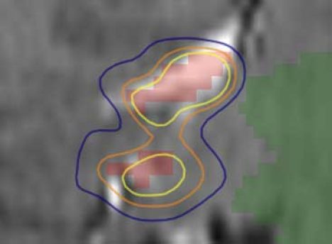 SMART DOSE DISTRIBUTIONS