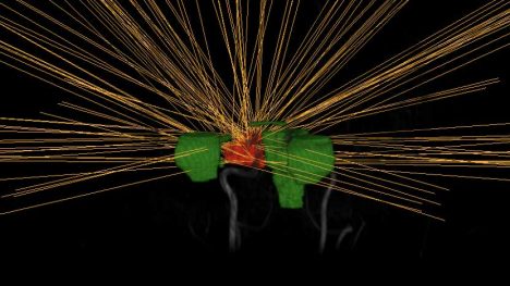 Maximize dose to target, minmimize dose to surrounding healthy tissue